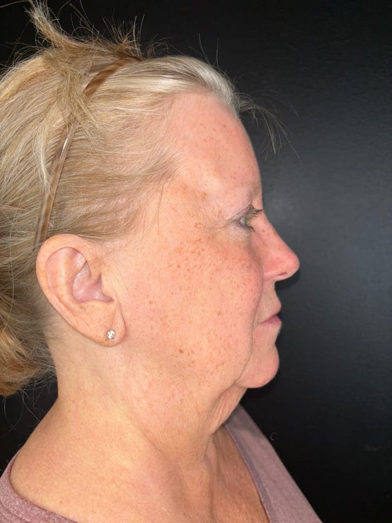 Panfacial Fat Grafting Before & After Gallery - Patient 383893 - Image 3
