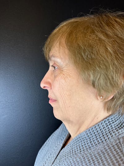 Neck Lift Before & After Gallery - Patient 286052 - Image 1