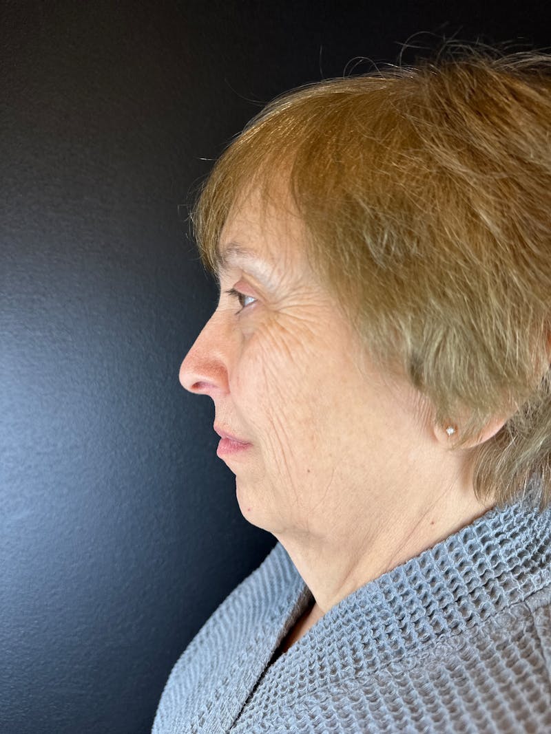 Neck Lift Before & After Gallery - Patient 286052 - Image 1