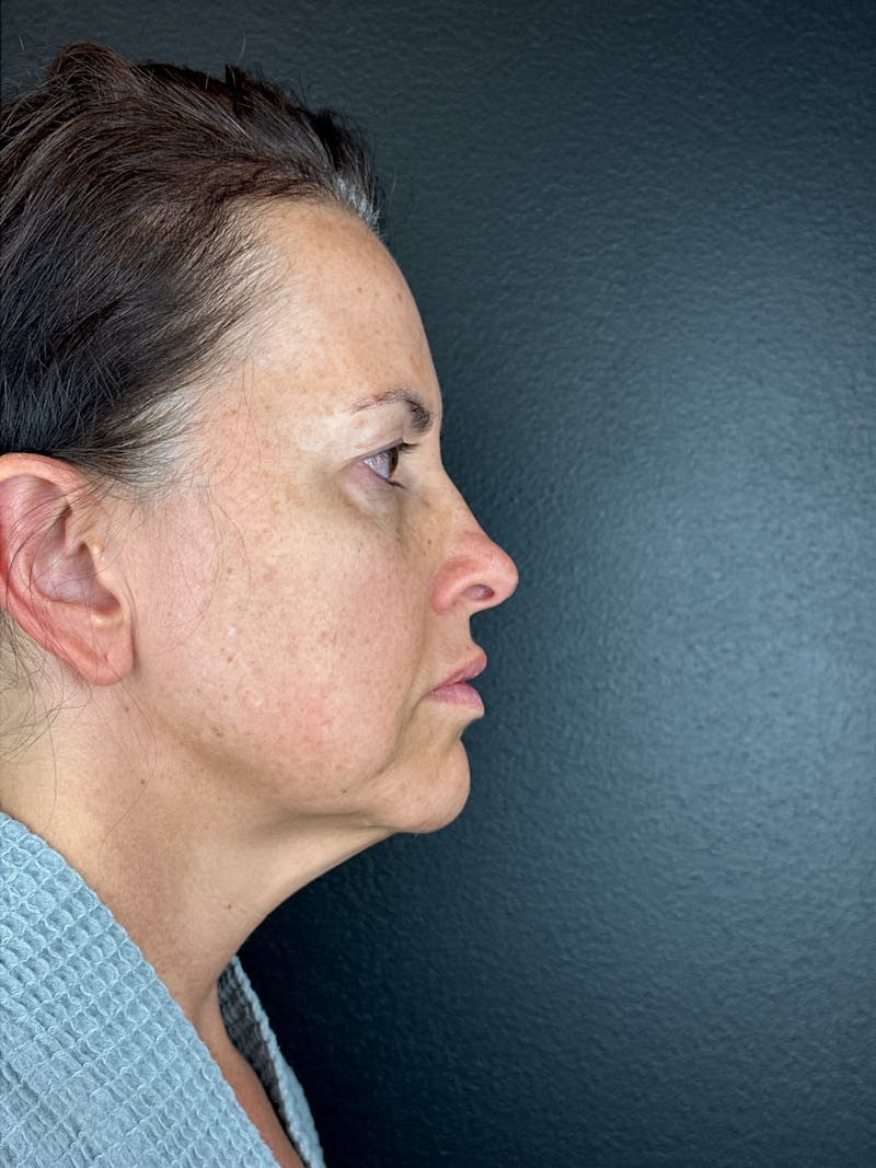 Panfacial Fat Grafting Before & After Gallery - Patient 387987 - Image 3