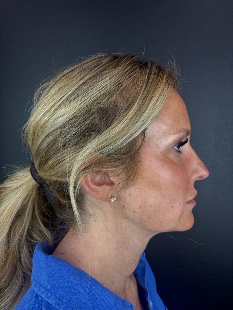 Neck Lift Before & After Gallery - Patient 306905 - Image 2