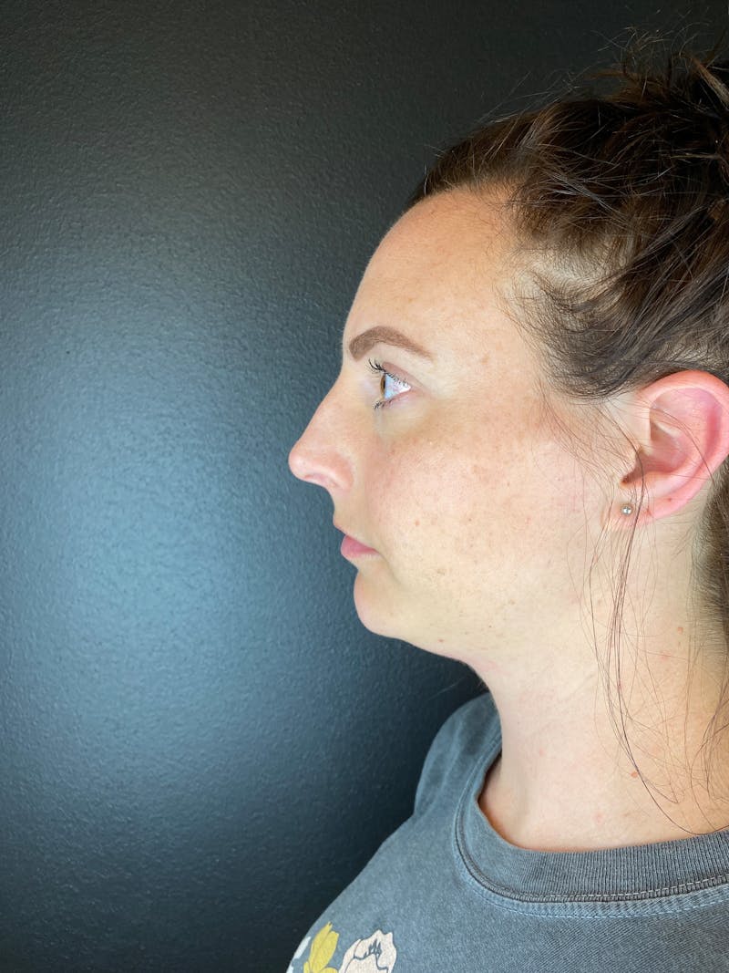 Neck Lift Before & After Gallery - Patient 208984 - Image 1