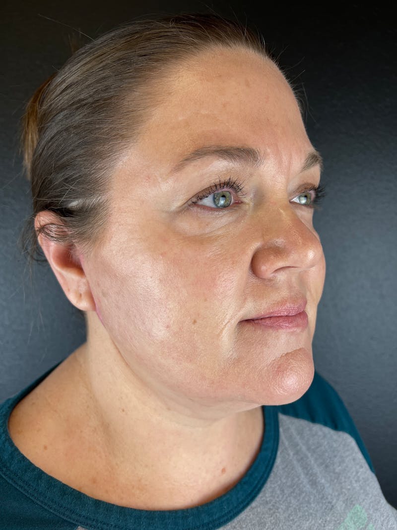 Neck Lift Before & After Gallery - Patient 308846 - Image 2