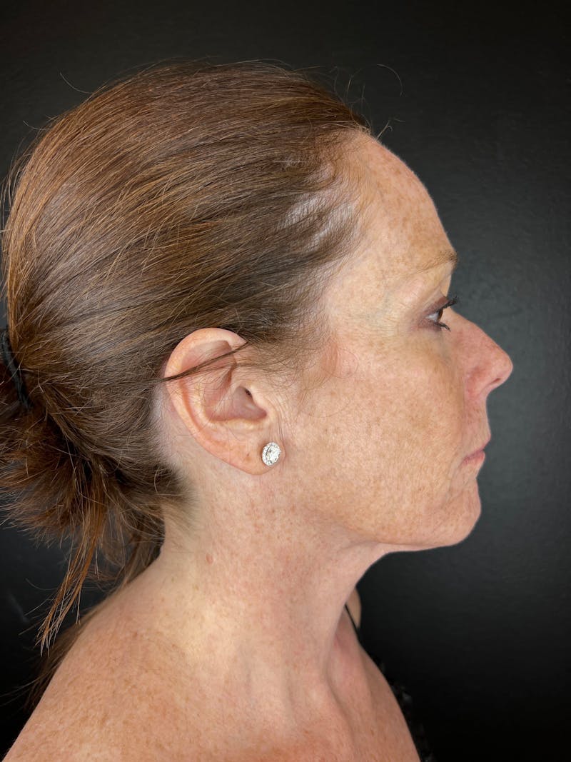 Neck Lift Before & After Gallery - Patient 335752 - Image 2