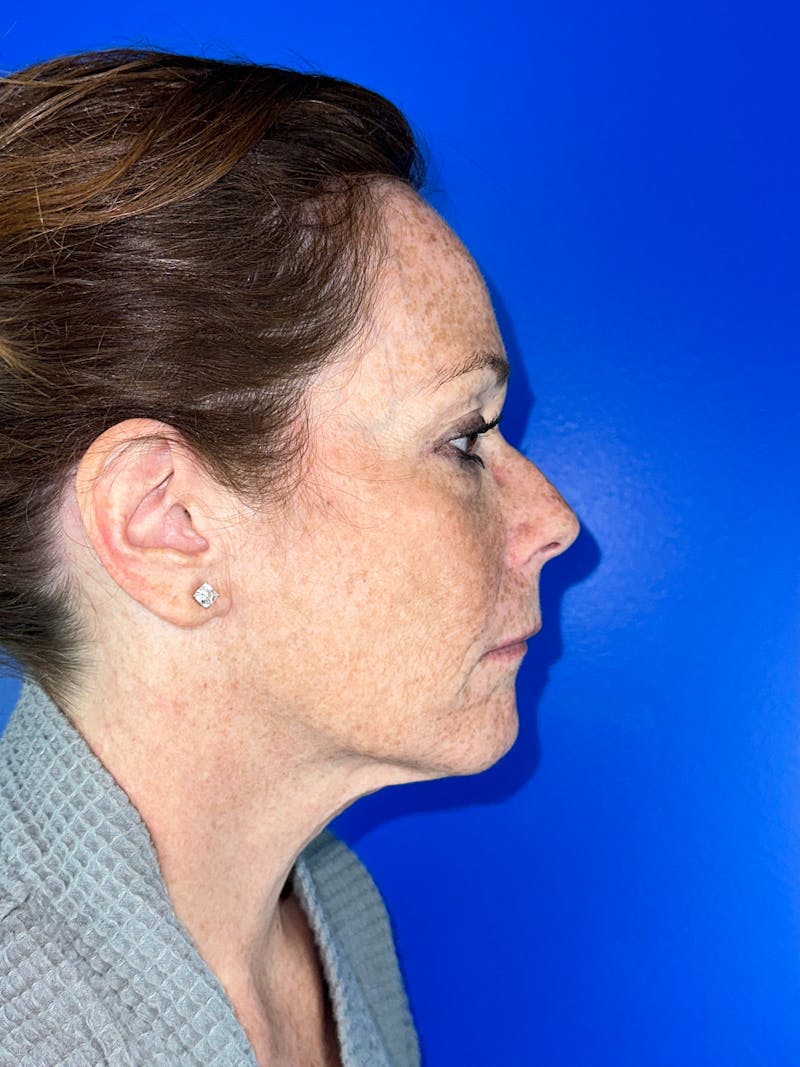 Neck Lift Before & After Gallery - Patient 335752 - Image 1