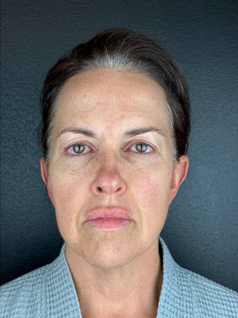 Panfacial Fat Grafting Before & After Gallery - Patient 387987 - Image 1