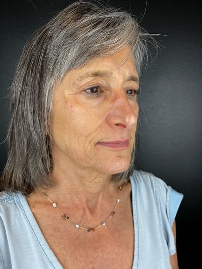Panfacial Fat Grafting Before & After Gallery - Patient 268819 - Image 1