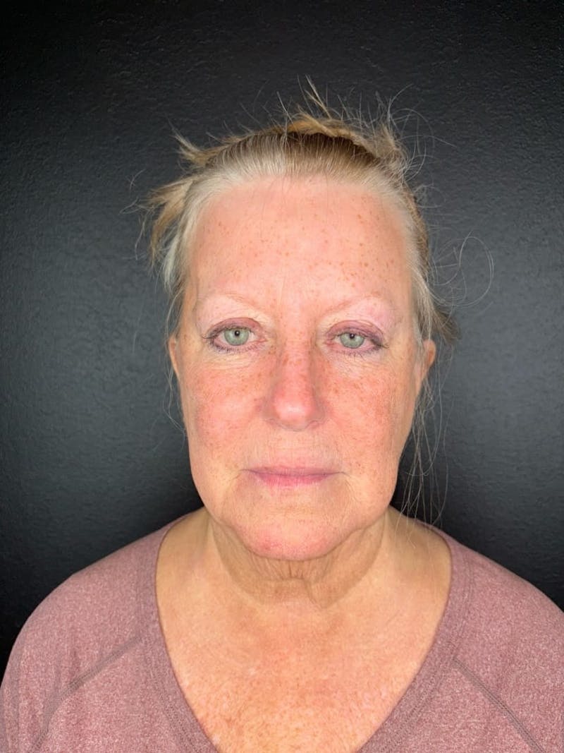 Panfacial Fat Grafting Before & After Gallery - Patient 383893 - Image 1