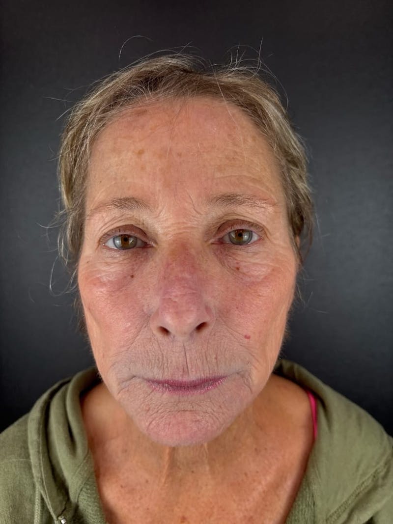 Panfacial Fat Grafting Before & After Gallery - Patient 212176 - Image 1