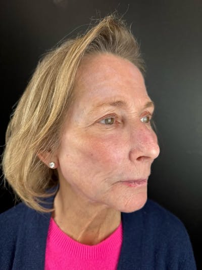 Skin Tightening Before & After Gallery - Patient 684114 - Image 2