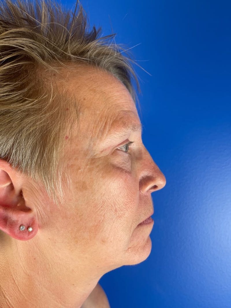 Panfacial Fat Grafting Before & After Gallery - Patient 483239 - Image 3