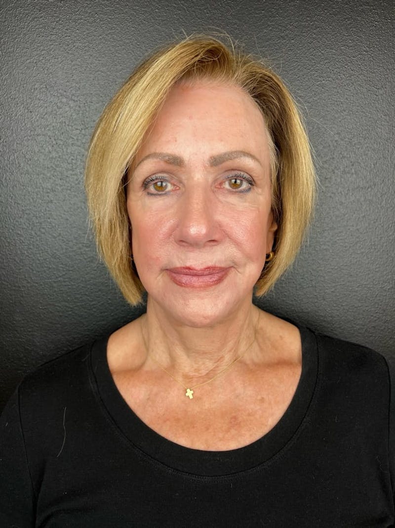 Panfacial Fat Grafting Before & After Gallery - Patient 149271 - Image 4