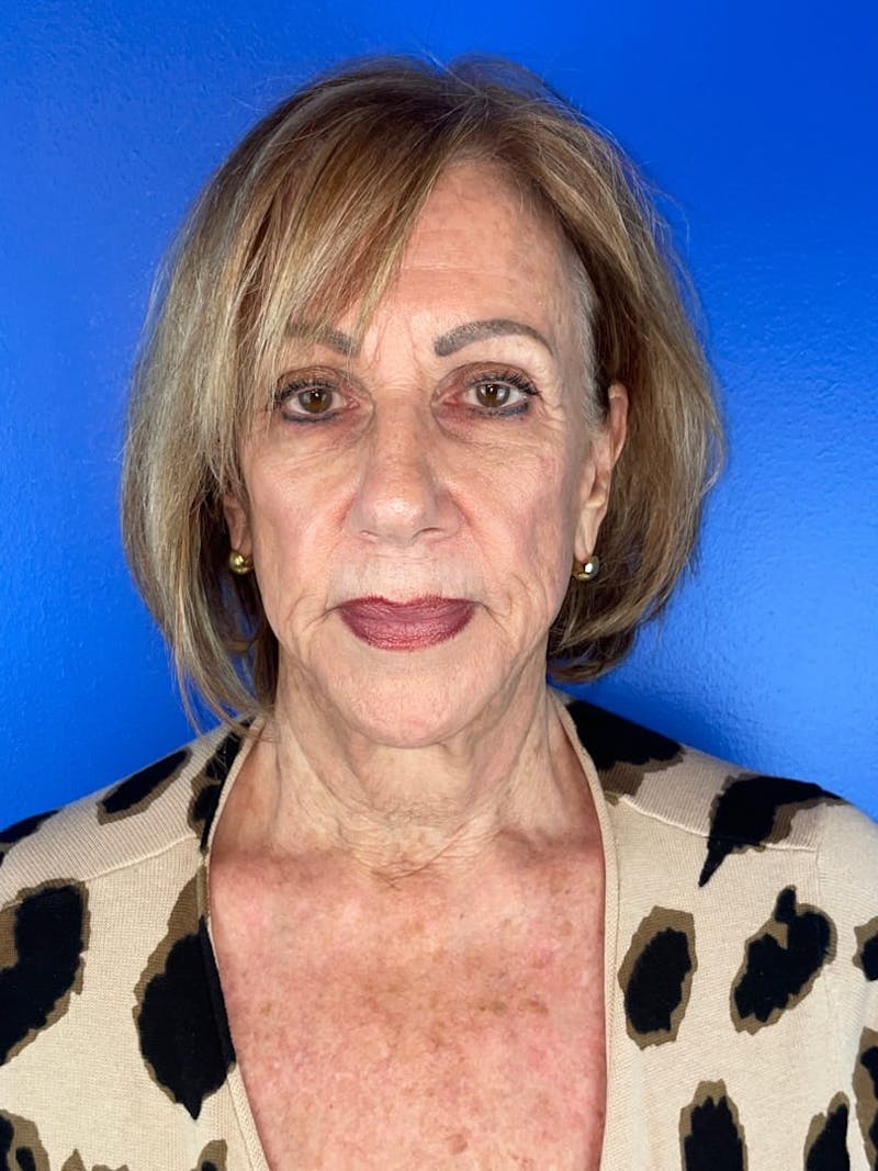 Panfacial Fat Grafting Before & After Gallery - Patient 149271 - Image 3