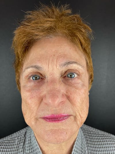 Skin Tightening Before & After Gallery - Patient 139254 - Image 1