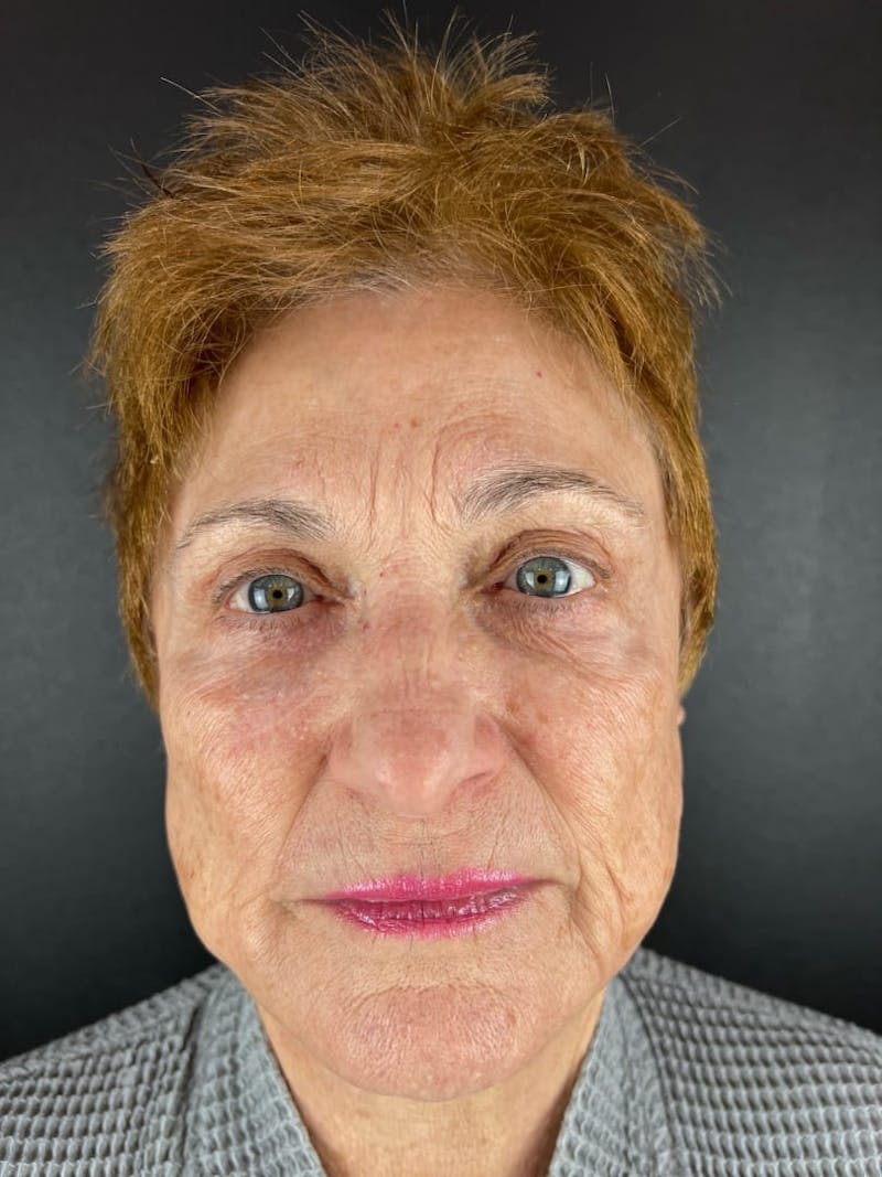 Skin Tightening Before & After Gallery - Patient 139254 - Image 1