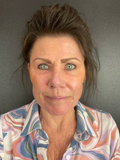 Skin Tightening Before & After Gallery - Patient 312637 - Image 2