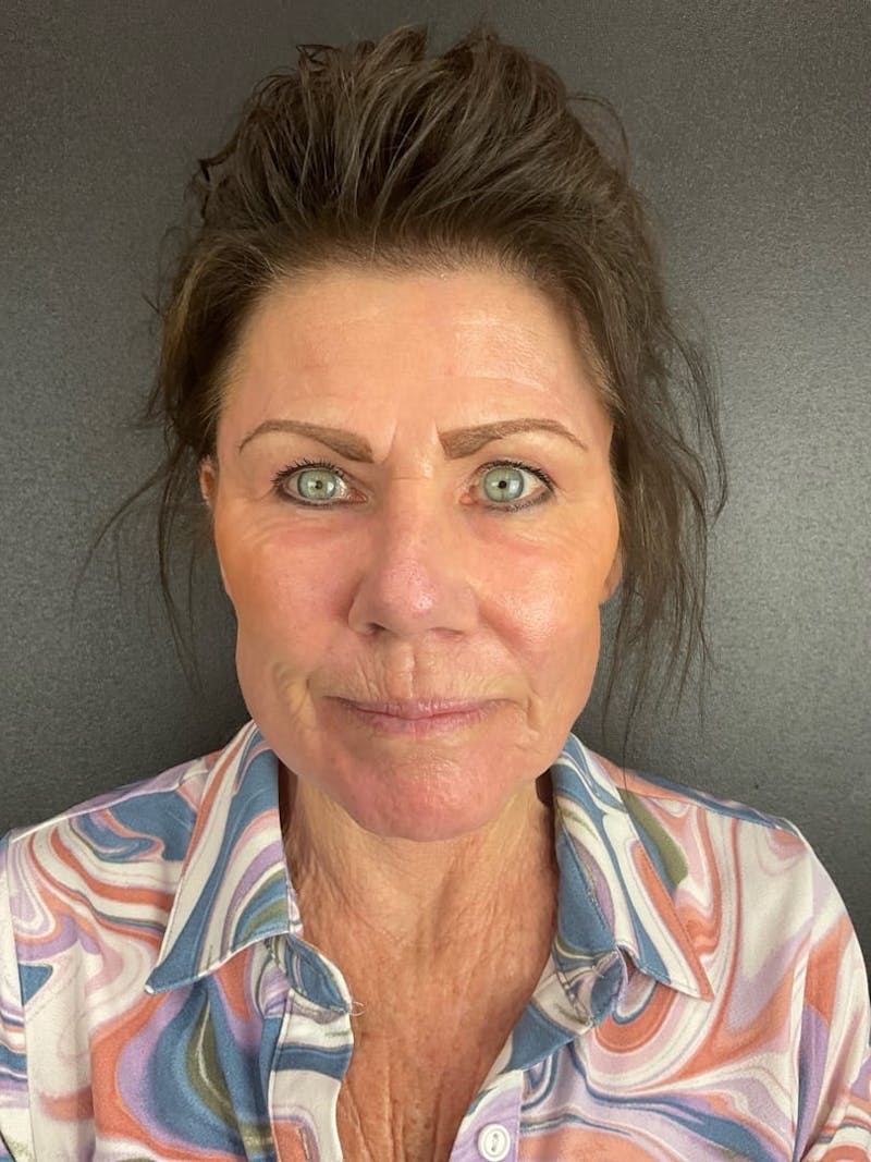 Skin Tightening Before & After Gallery - Patient 312637 - Image 2
