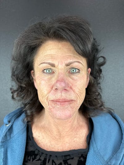Skin Tightening Before & After Gallery - Patient 312637 - Image 1