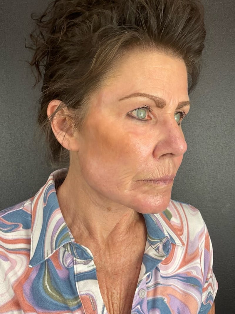 Skin Tightening Before & After Gallery - Patient 312637 - Image 4