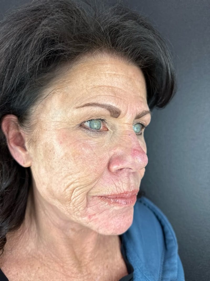 Skin Tightening Before & After Gallery - Patient 312637 - Image 3