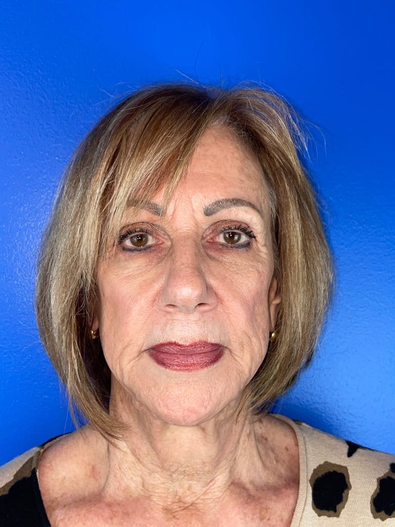 Skin Tightening Before & After Gallery - Patient 325203 - Image 3