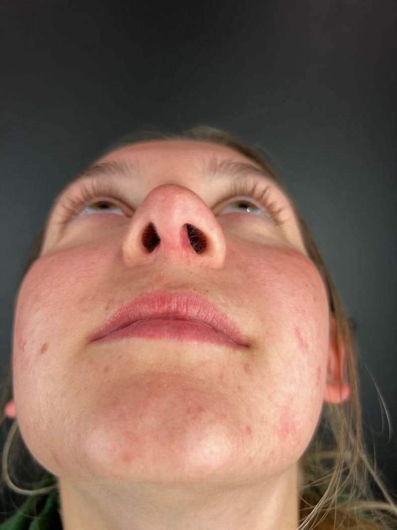 Rhinoplasty Before & After Gallery - Patient 242615 - Image 4