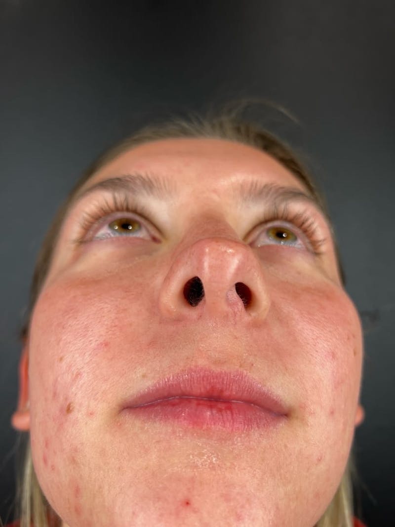 Rhinoplasty Before & After Gallery - Patient 242615 - Image 3