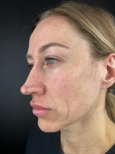 Rhinoplasty Before & After Gallery - Patient 150884 - Image 1