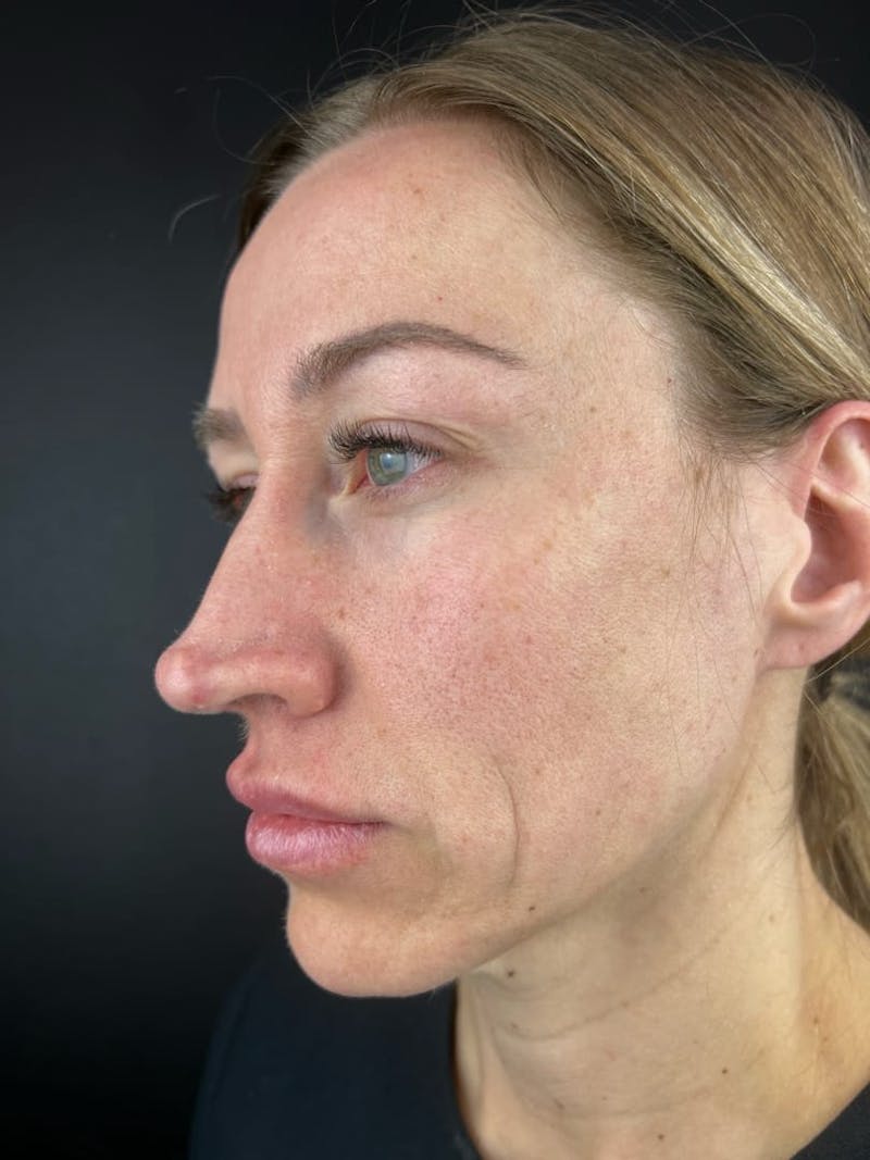 Rhinoplasty Before & After Gallery - Patient 150884 - Image 1