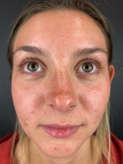 Rhinoplasty Before & After Gallery - Patient 242615 - Image 1