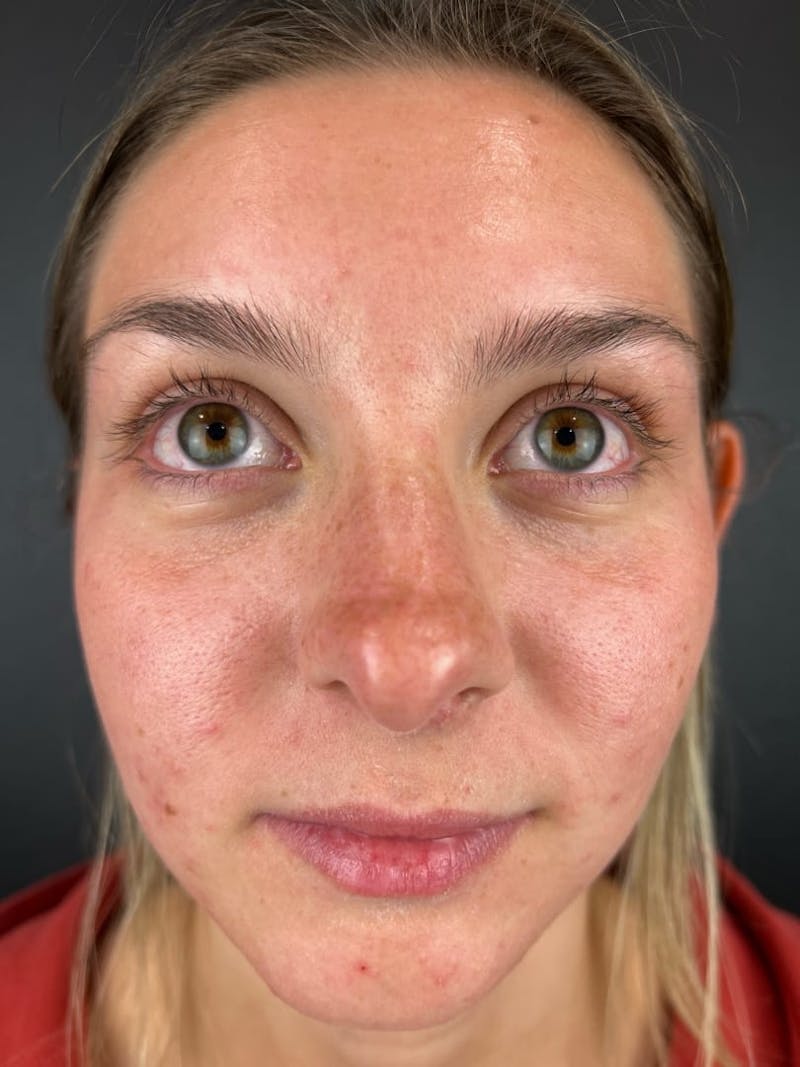 Rhinoplasty Before & After Gallery - Patient 242615 - Image 1