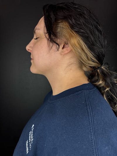 Submental Liposuction Before & After Gallery - Patient 105449 - Image 2