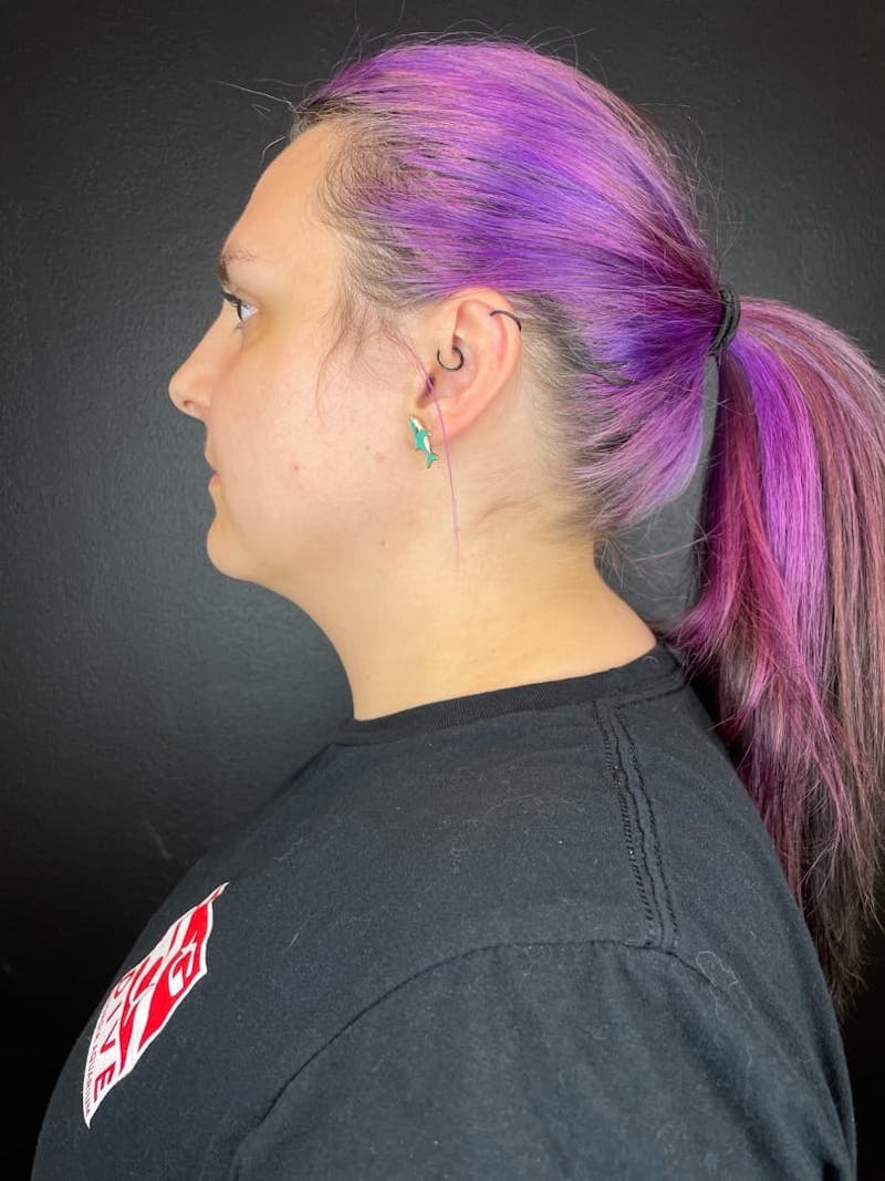 Submental Liposuction Before & After Gallery - Patient 105449 - Image 1