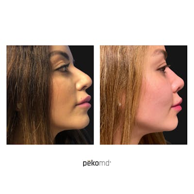 Rhinoplasty Before & After Gallery - Patient 167405 - Image 1