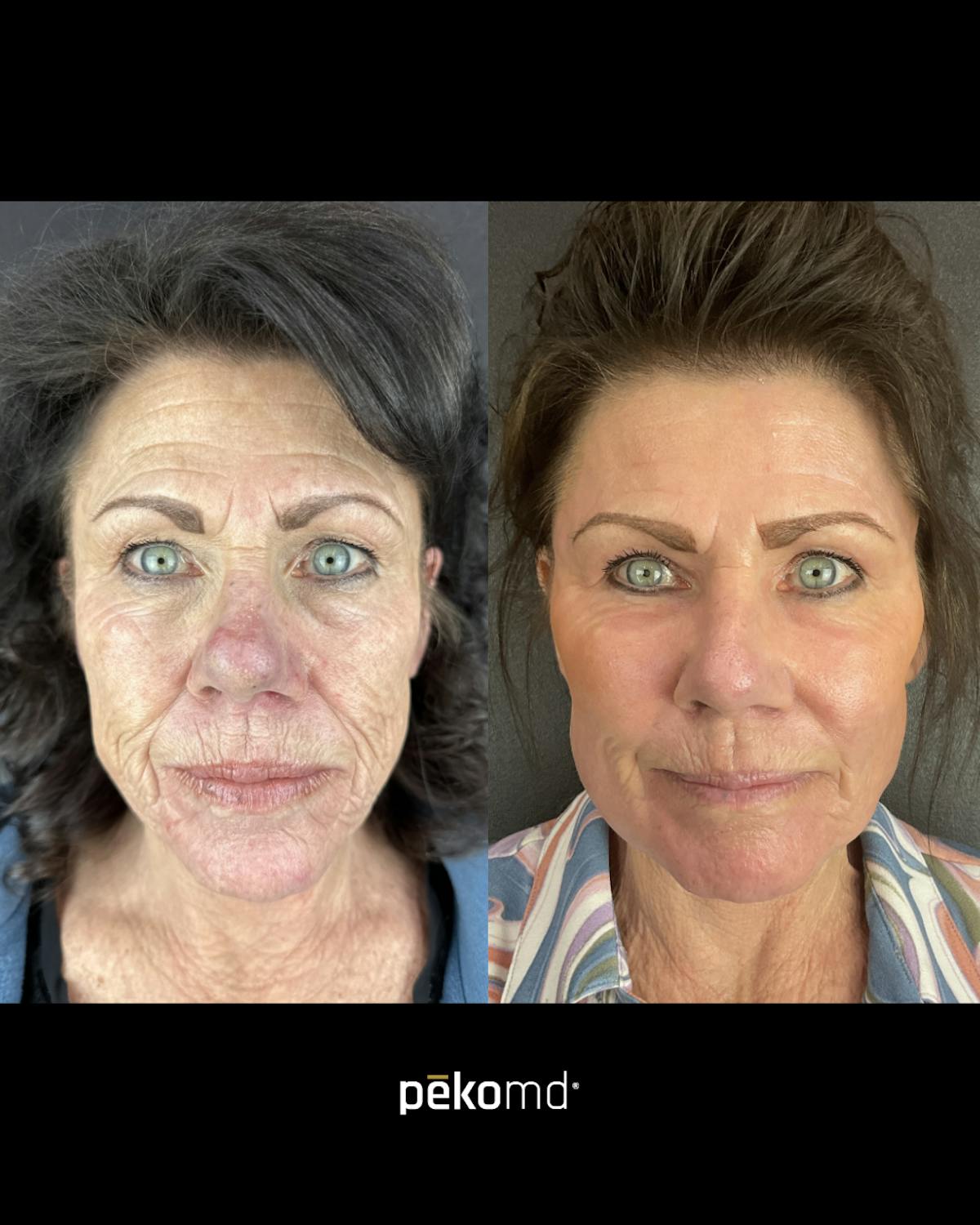 Panfacial Fat Grafting Before & After Gallery - Patient 316189 - Image 1