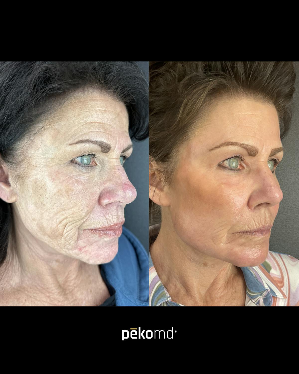 Panfacial Fat Grafting Before & After Gallery - Patient 316189 - Image 2
