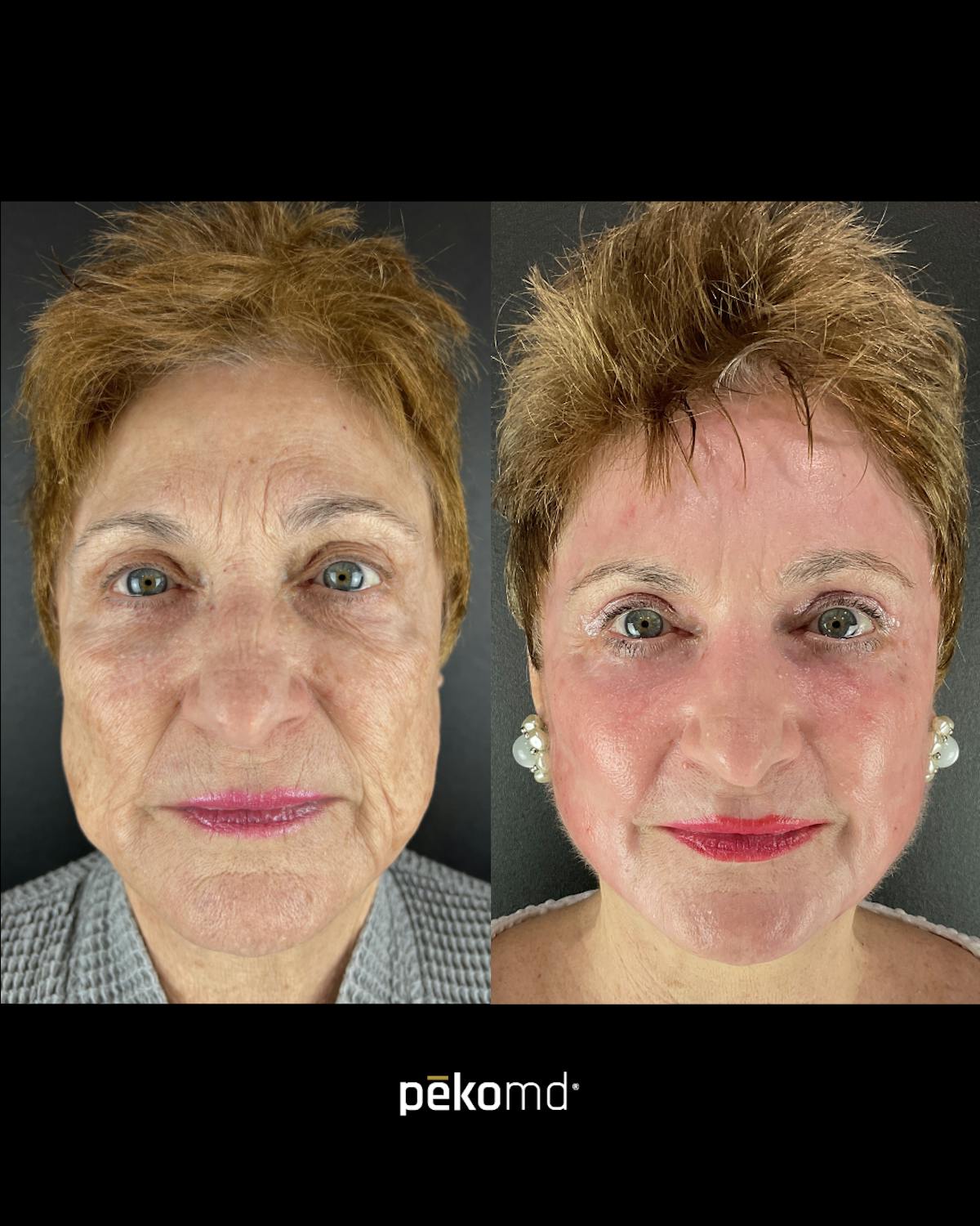 Panfacial Fat Grafting Before & After Gallery - Patient 225735 - Image 1