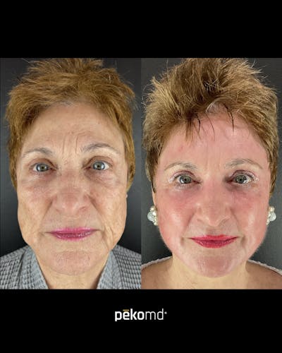 Panfacial Fat Grafting Before & After Gallery - Patient 225735 - Image 1
