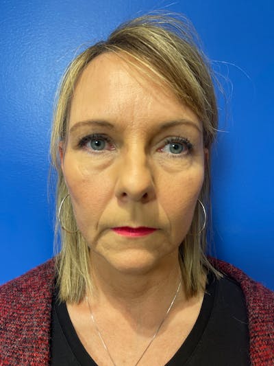 Panfacial Fat Grafting Before & After Gallery - Patient 101127 - Image 1