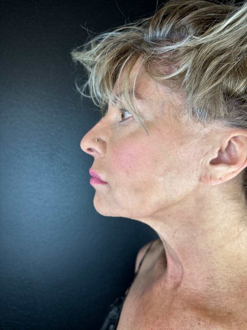 Neck Lift Before & After Gallery - Patient 157112 - Image 1