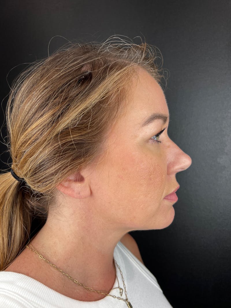Neck Lift Before & After Gallery - Patient 618246 - Image 2