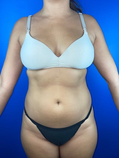 Abdomen (Liposuction) Before & After Gallery - Patient 173582 - Image 1