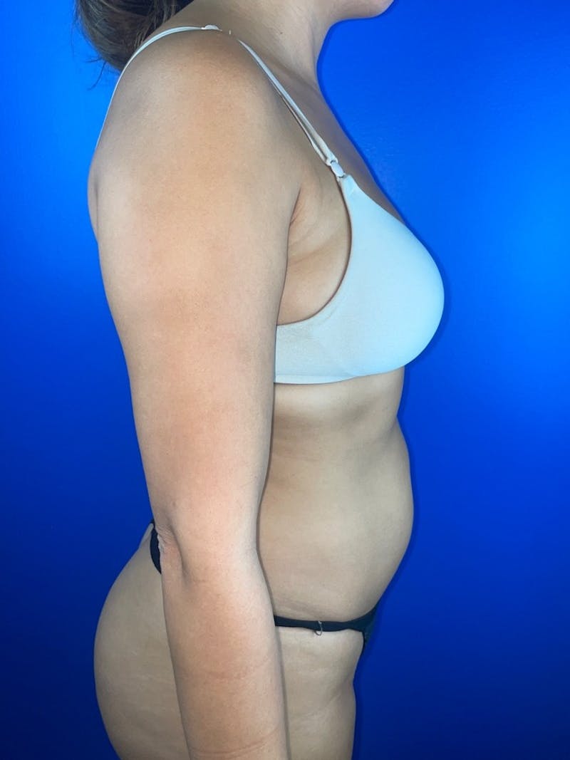Abdomen (Liposuction) Before & After Gallery - Patient 173582 - Image 3