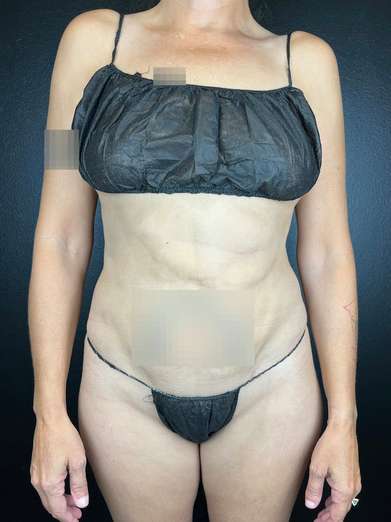 Abdomen (Liposuction) Before & After Gallery - Patient 249447 - Image 2