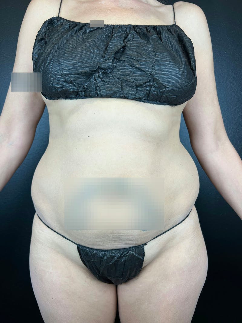 Abdomen (Liposuction) Before & After Gallery - Patient 249447 - Image 1