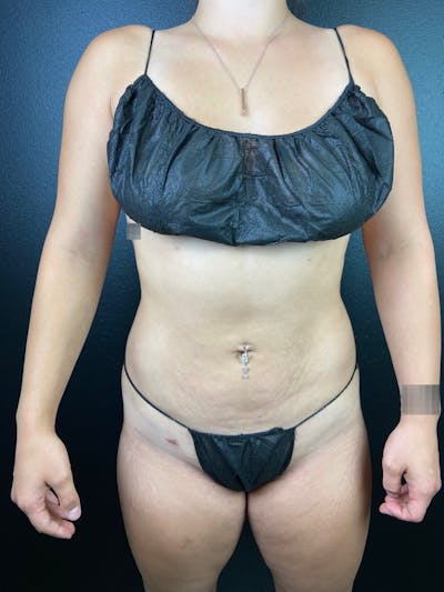 Abdomen (Liposuction) Before & After Gallery - Patient 169978 - Image 2