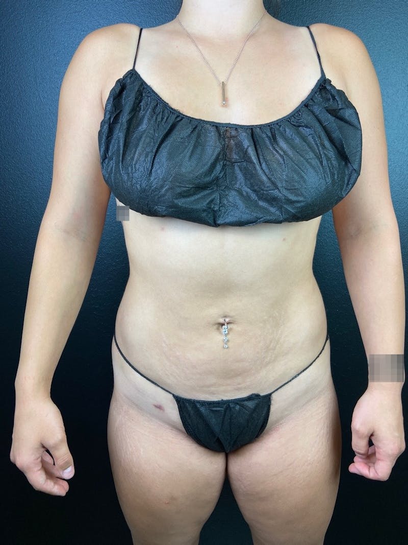 Abdomen (Liposuction) Before & After Gallery - Patient 169978 - Image 2