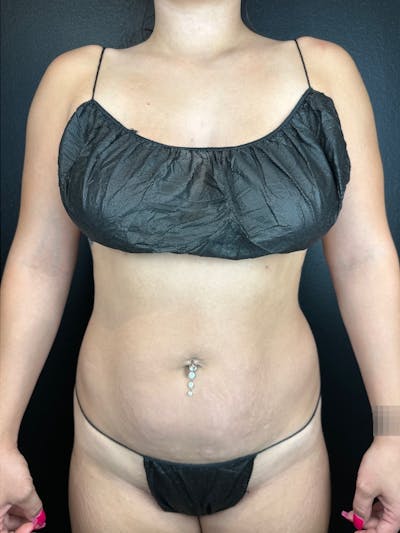 Abdomen (Liposuction) Before & After Gallery - Patient 169978 - Image 1