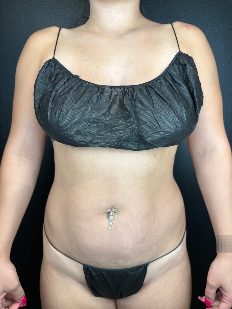 Abdomen (Liposuction) Before & After Gallery - Patient 169978 - Image 1