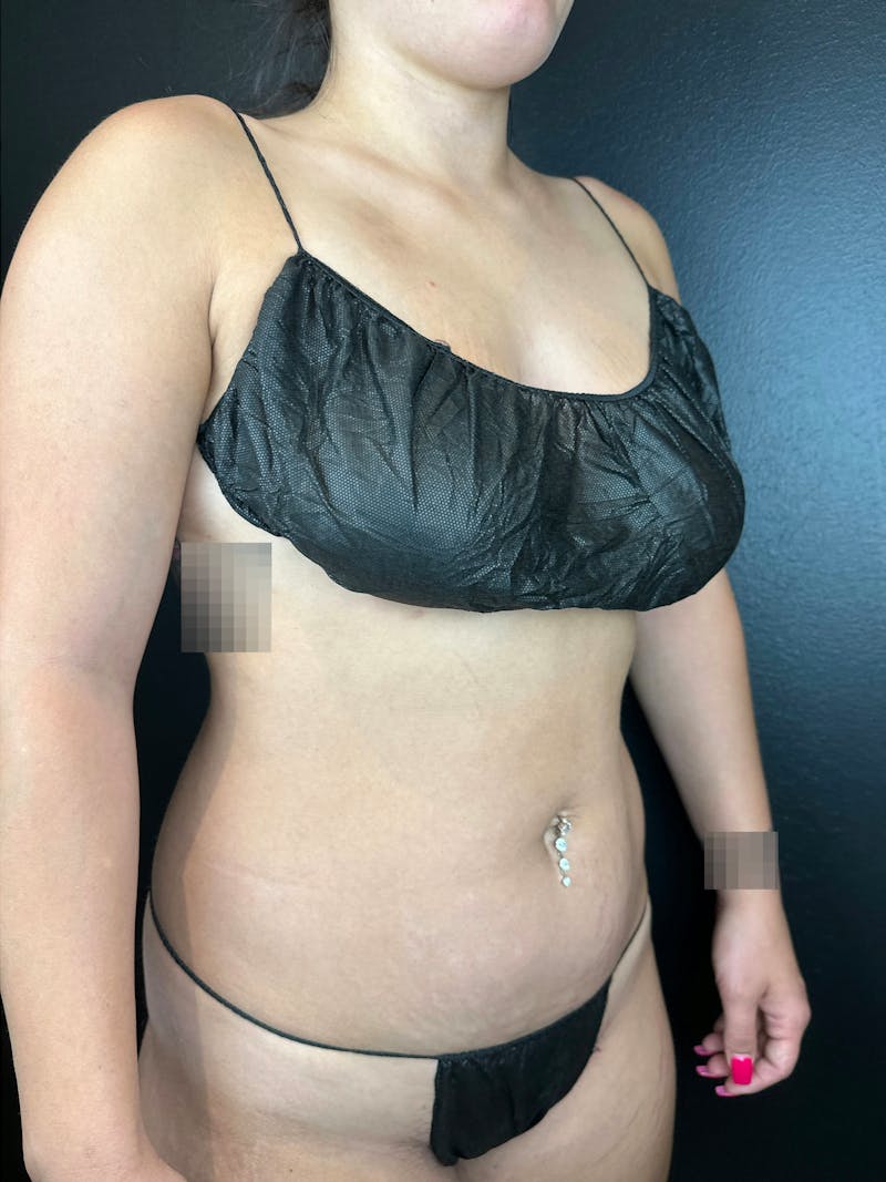 Abdomen (Liposuction) Before & After Gallery - Patient 169978 - Image 3